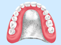 総入れ歯