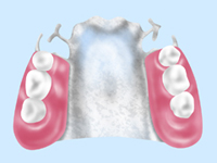 部分入れ歯