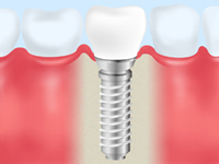 当院のインプラント