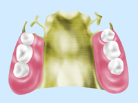部分入れ歯