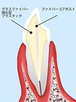 メリットいっぱい！ファイバーコアポスト