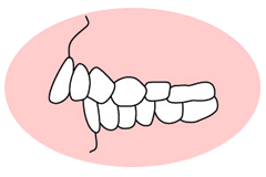 上顎前突（出っ歯）
