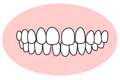 空隙歯列（すきっ歯）