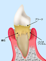 歯がグラグラすると思ったら