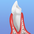 歯周病とは