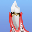歯周病とは