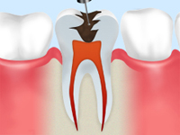 根管治療とは